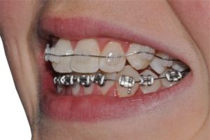 حلقه ارتودنسی