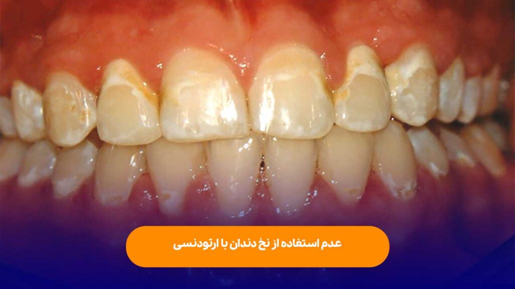 عدم استفاده از نخ دندان با ارتودنسی