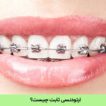 ارتودنسی ثابت