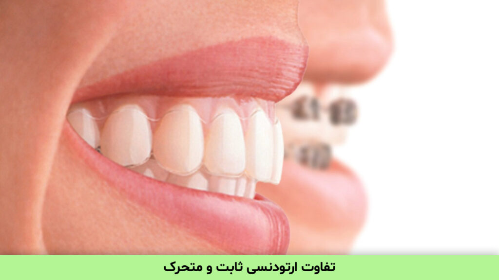 تفاوت ارتودنسی ثابت و متحرک