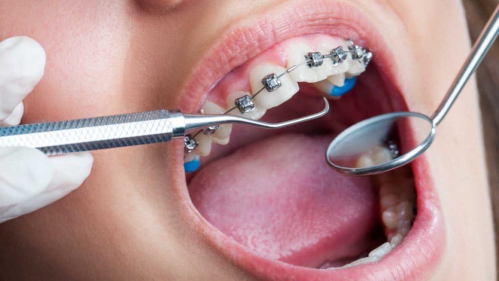 مراحل ارتودنسی دندان ثابت
