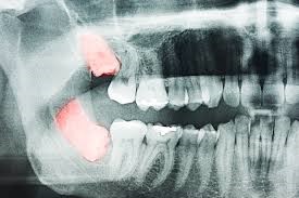 ارتودنسی دندان پنهان