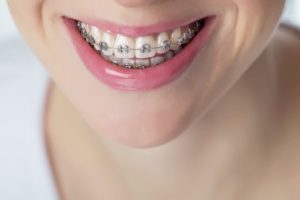 هزینه ارتودنسی ثابت دندان