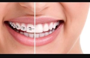 مراحل ارتودنسی دندان ثابت 