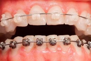 مراحل ارتودنسی دندان ثابت 