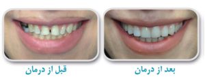ارتودنسی دو دندان جلو، فاصله-بین-دندان