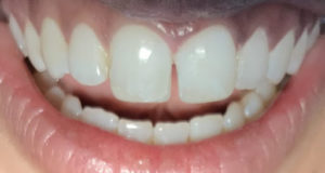 ارتودنسی دو دندان جلو، فاصله-بین-دندان