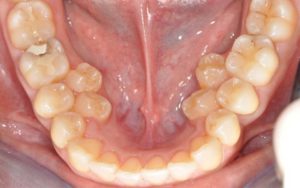 ارتودنسی دندان اضافی3