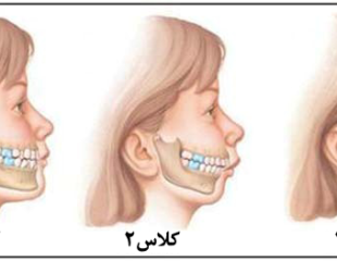 ارتودنسی کامفولاژ-1