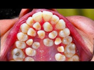 ارتودنسی دندان اضافی2