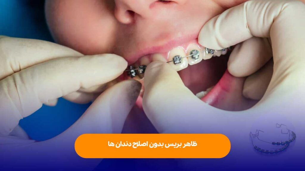 ارتودنسی فیک چگونه انجام می شود؟