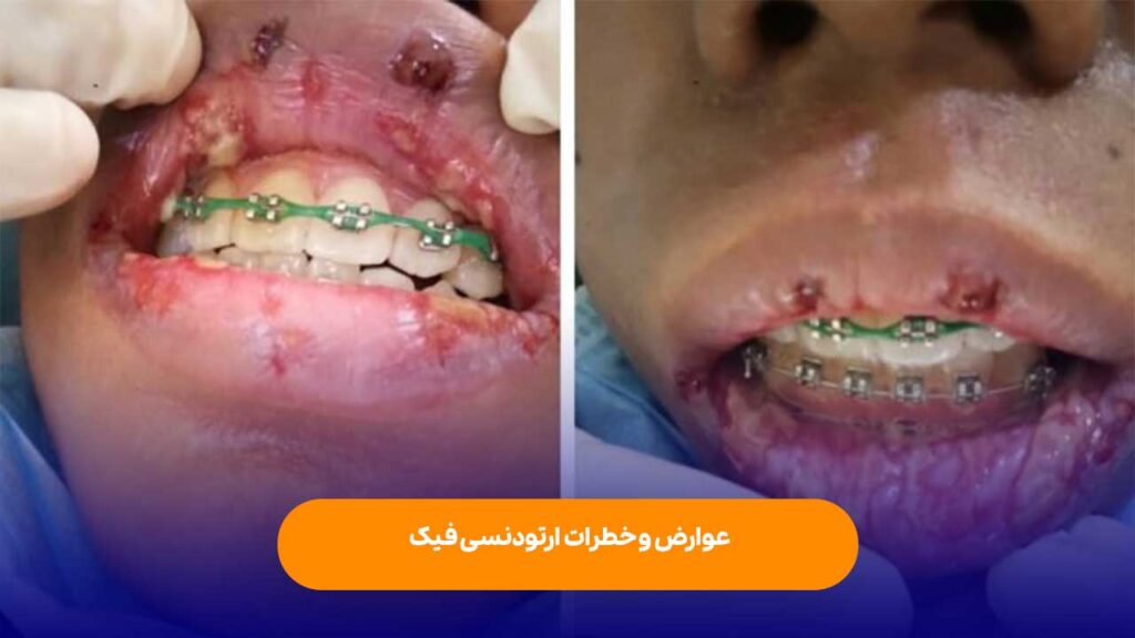عوارض و خطرات ارتودنسی فیک برای دندان و لثه