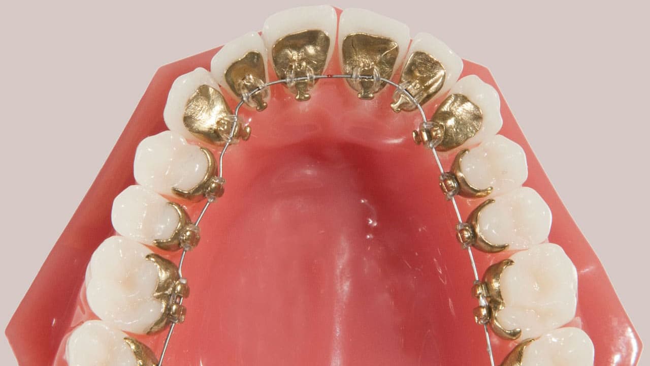 تفاوت ارتودنسی پشت دندان با ارتودنسی معمولی