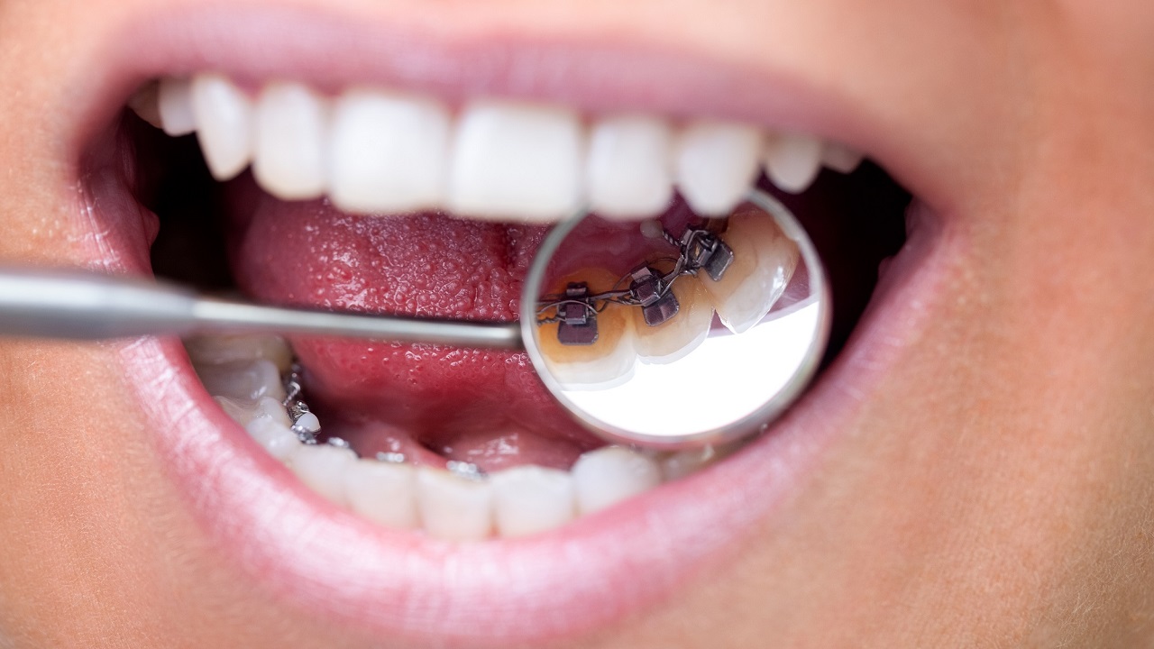 مشکلات قابل درمان با ارتودنسی پشت دندان