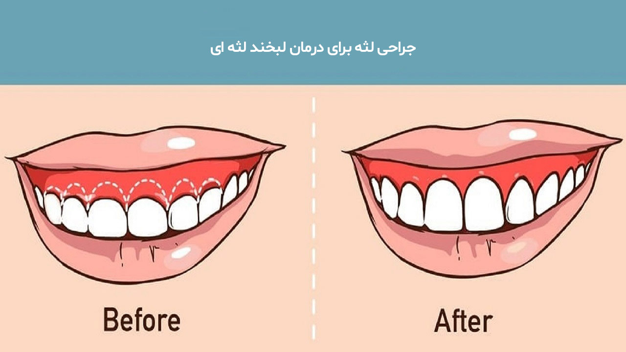 جراحی لثه برای درمان لبخند لثه ای