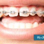 ارتودنسی فک بالا