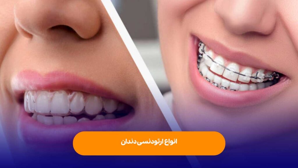 انواع ارتودنسی دندان