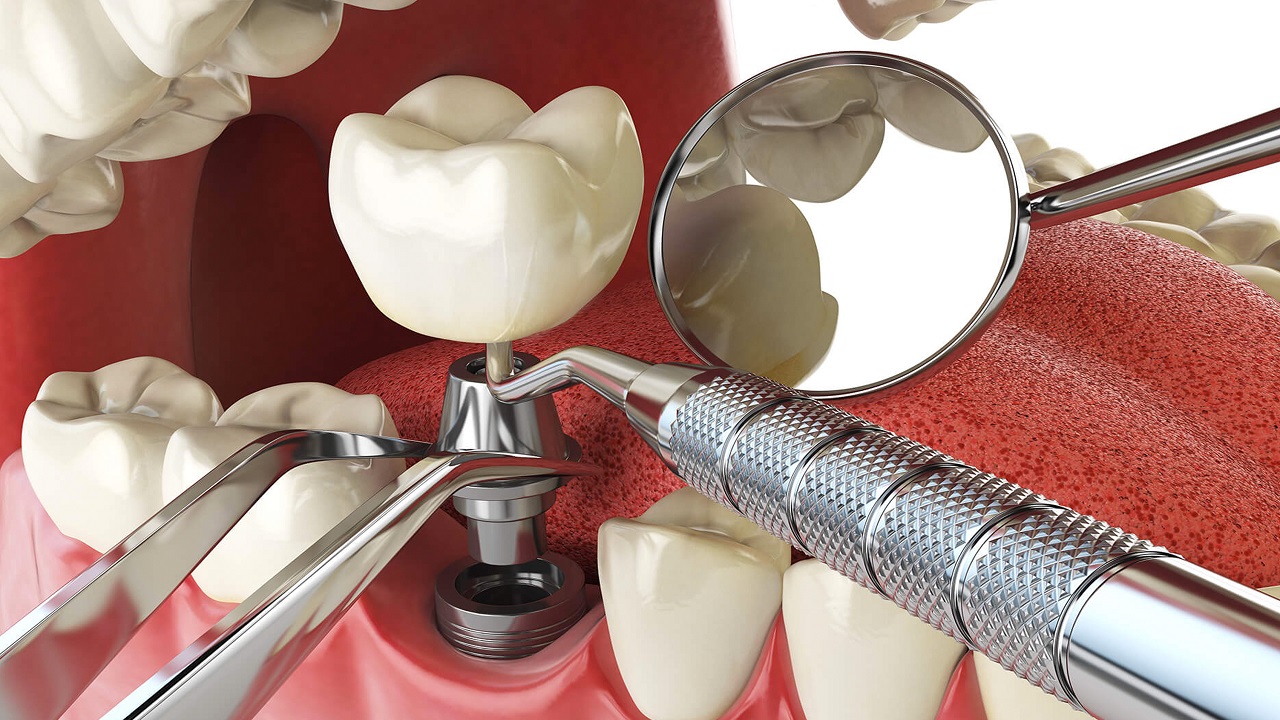 اجزای مختلف ایمپلنت دندان
