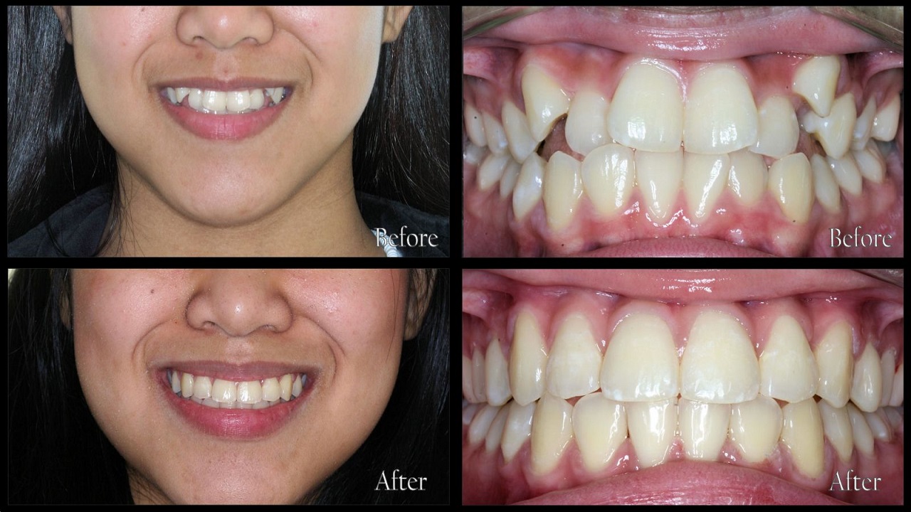 درمان شلوغی و نامظمی دندان با ارتودنسی