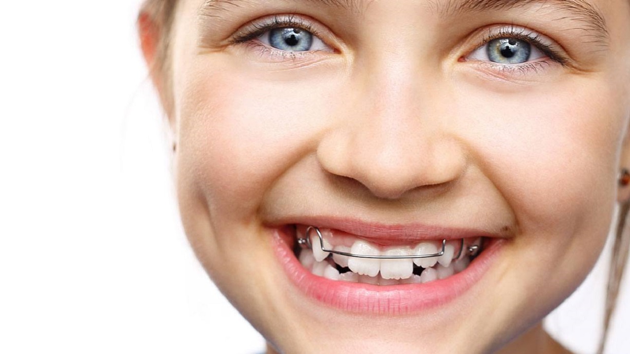 پلاک متحرک بر روی دندان های کودک