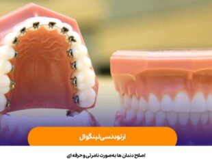 ارتودنسی لینگوال