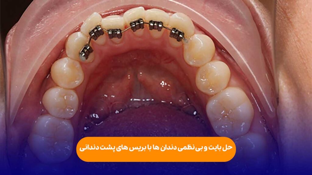 حل بایت و بی‌نظمی دندان‌ها با بریس‌های پشت دندانی