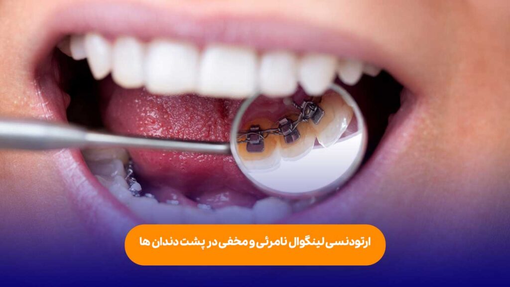 نامرئی بودن ارتودنسی لینگوال