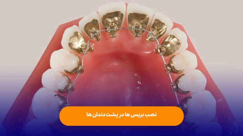 نصب بریس‌ها در پشت دندان‌ها
