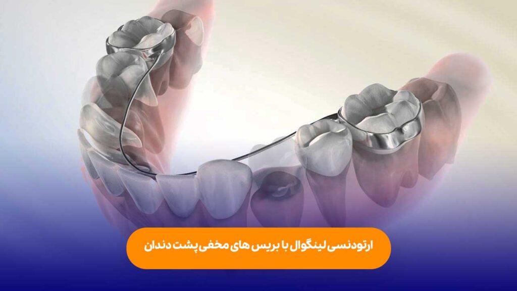 ارتودنسی لینگوال یا پشت دندانی چیست؟
