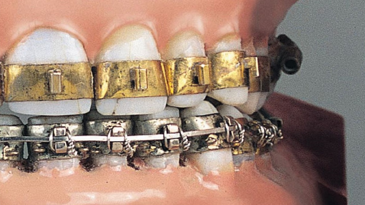 ارتودنسی دندان در سال 1970