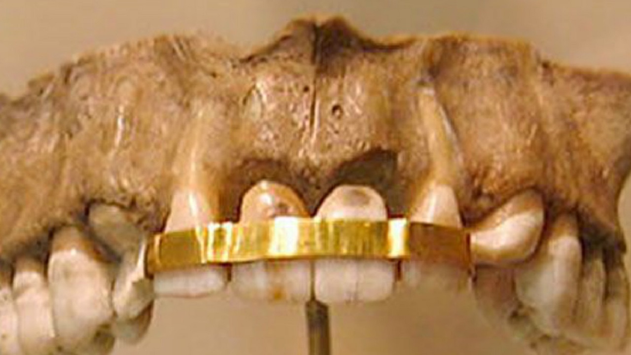 نوارهای فلزی ارتودنسی بر روی دندانها