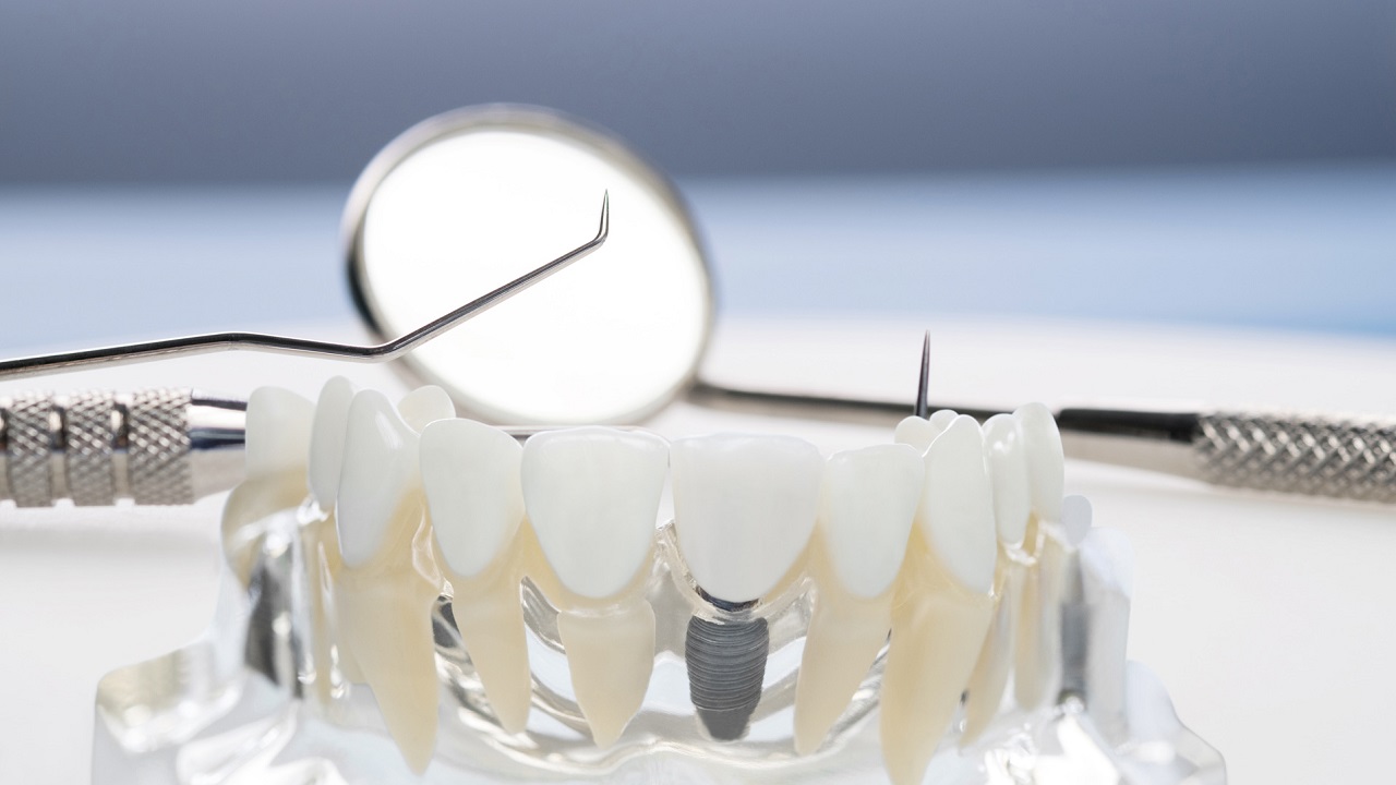 تکنیک ایمپنت دندان
