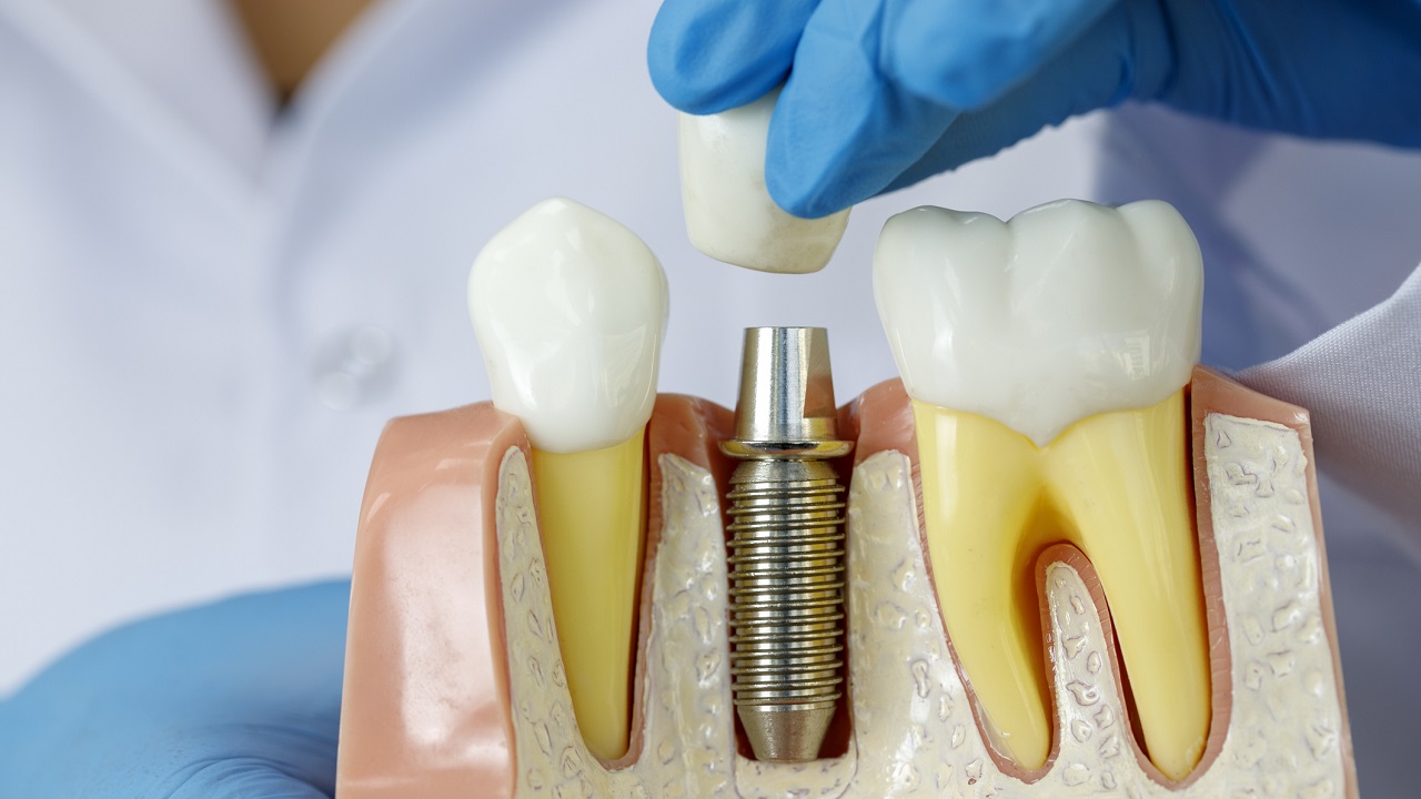قرارگیری ایمپلنت دندان در استخوان فک