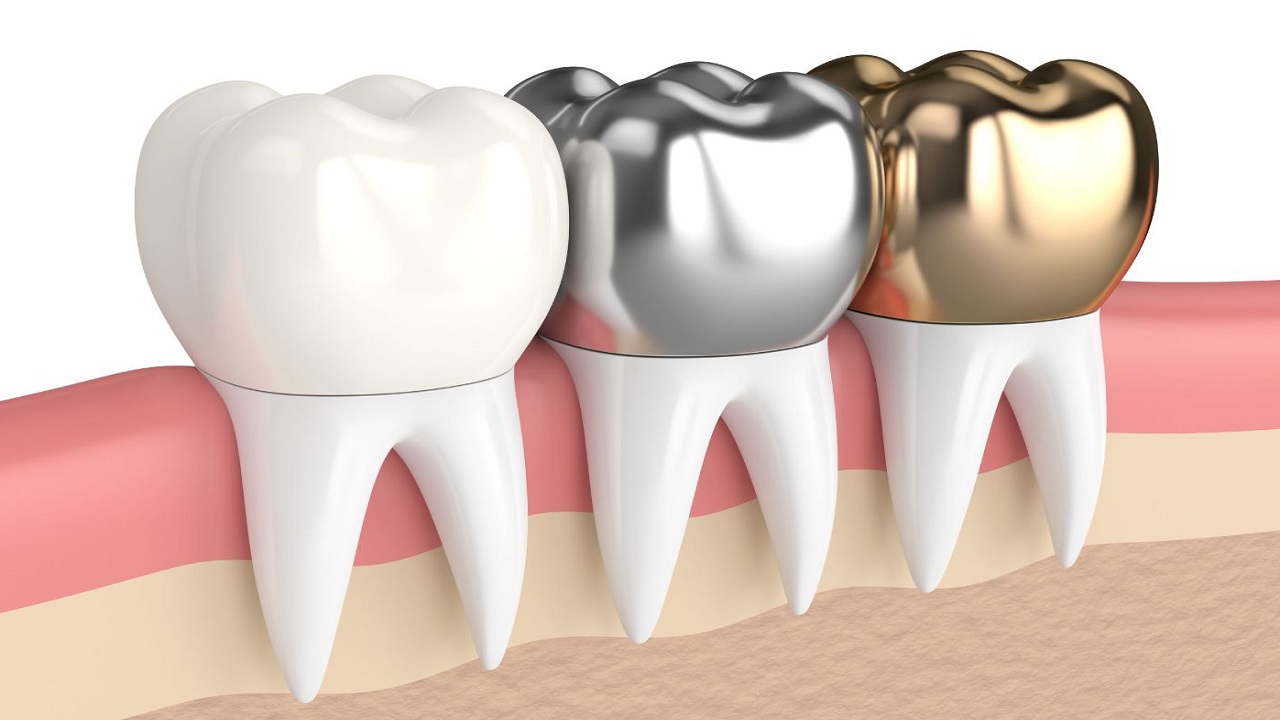 انواع مواد روکش دندان