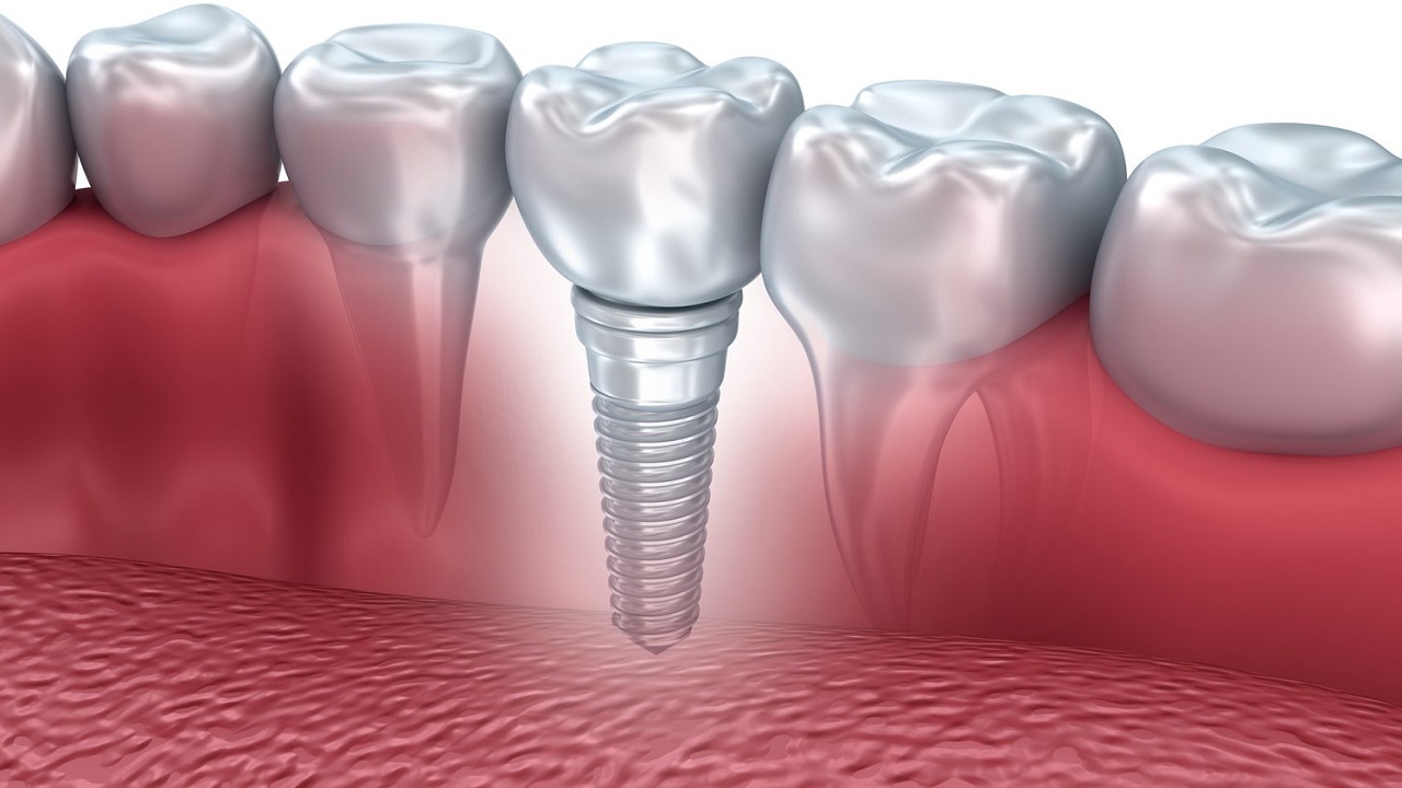 ایمپلنت دندان