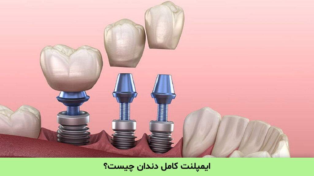 ایمپلنت کامل دندان