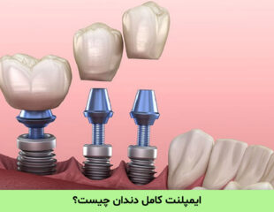 ایمپلنت کامل دندان
