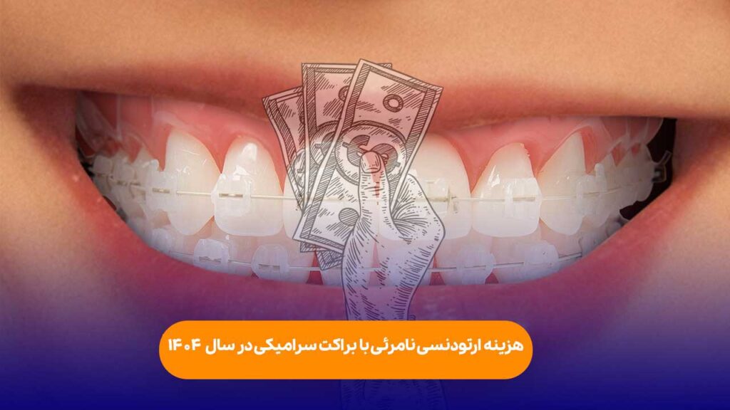 هزینه ارتودنسی نامرئی با براکت سرامیکی 