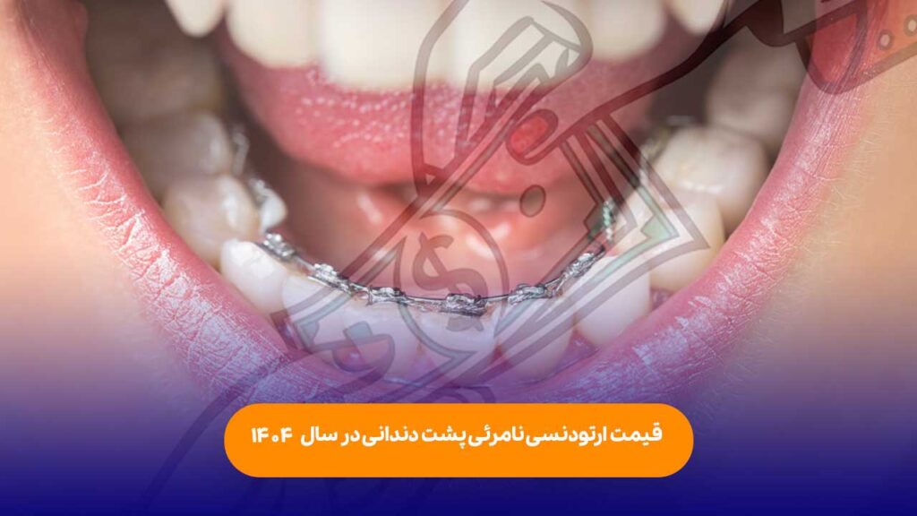 قیمت ارتودنسی نامرئی پشت دندانی (سیستم لینگوال)