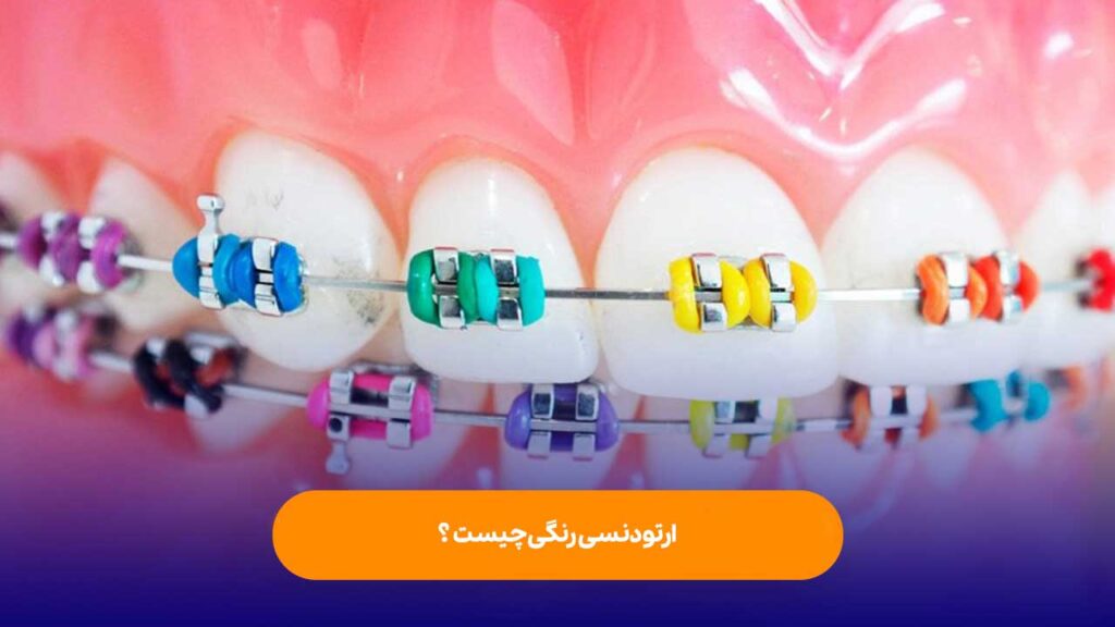 ارتودنسی رنگی چیست