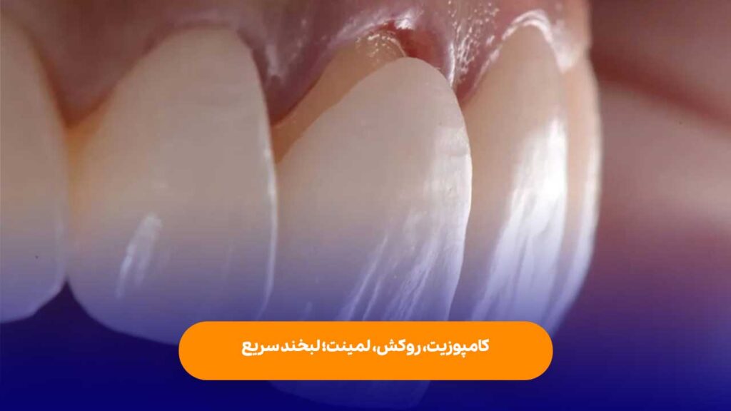 کامپوزیت، روکش، لمینت؛ لبخند سریع