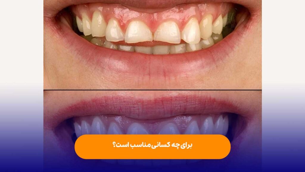 ارتودنسی سریع برای چه کسانی مناسب است؟